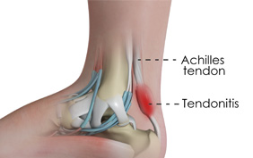 achilles tendon tendonitis